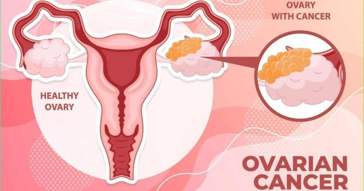 Ovarian Cancer Signs : Expert Insights from the best Gynecologic Oncologist in Delhi | Dr Divya Sehra