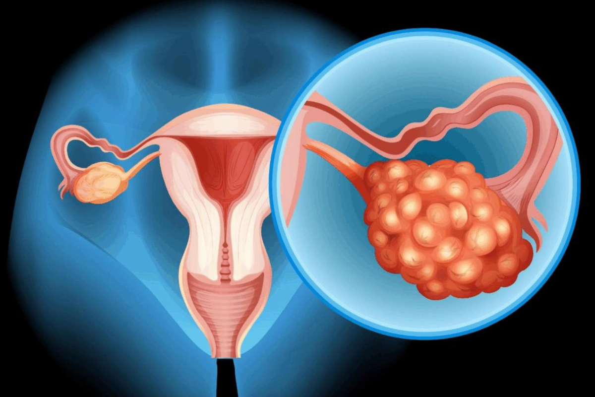 Everything You Need to Know Before and After Ovarian Cancer Surgery in Delhi | Dr Divya Sehra