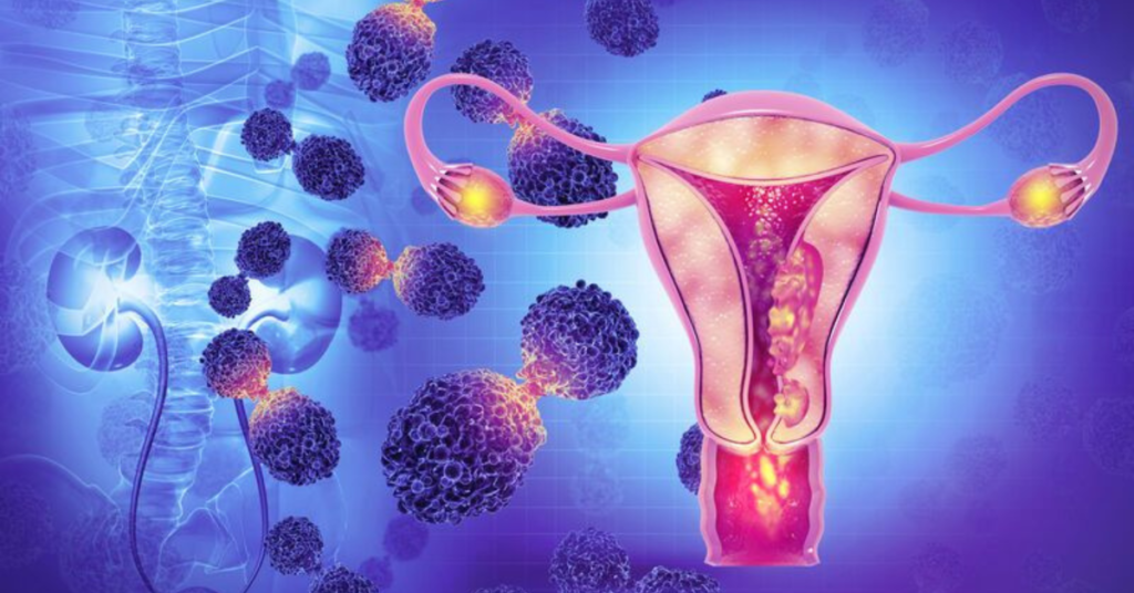 Best Treatment for Cervical Cancer in Delhi | Dr Divya Sehra